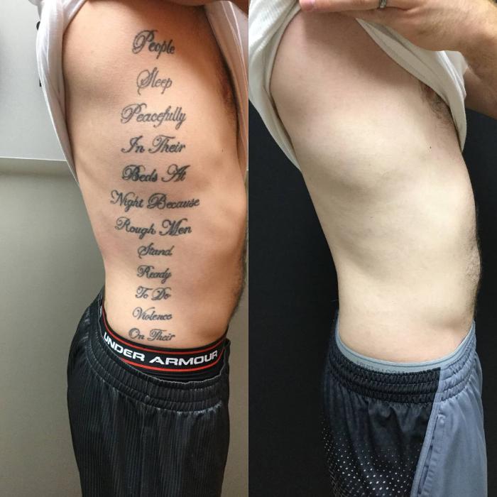 Removery Tattoo Removal & Fading