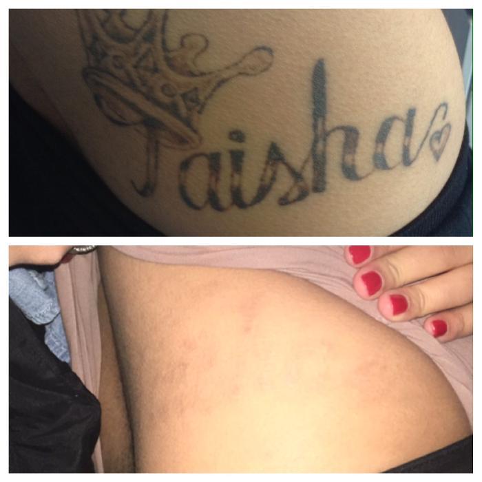 Removery Tattoo Removal & Fading
