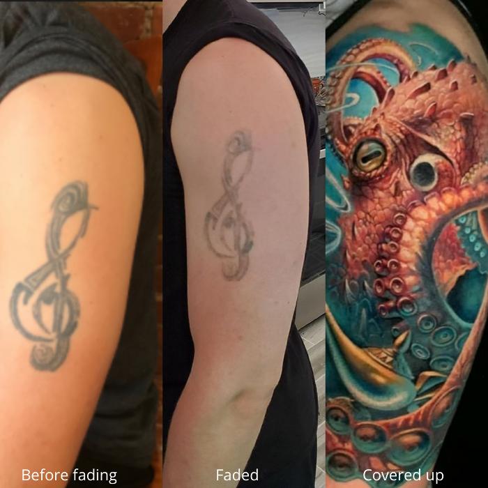 Removery Tattoo Removal & Fading
