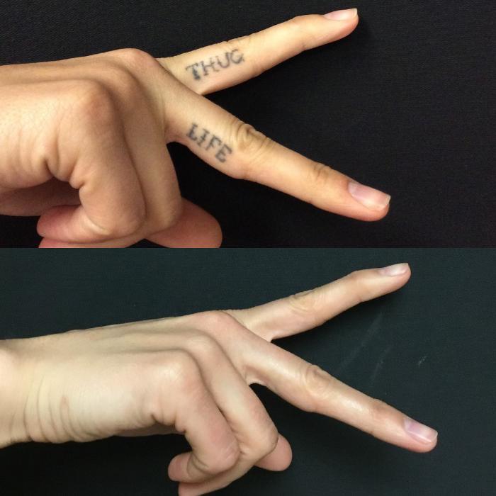 Removery Tattoo Removal & Fading