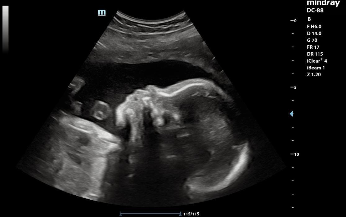 UC Baby Winnipeg (Previous Fetoscan)