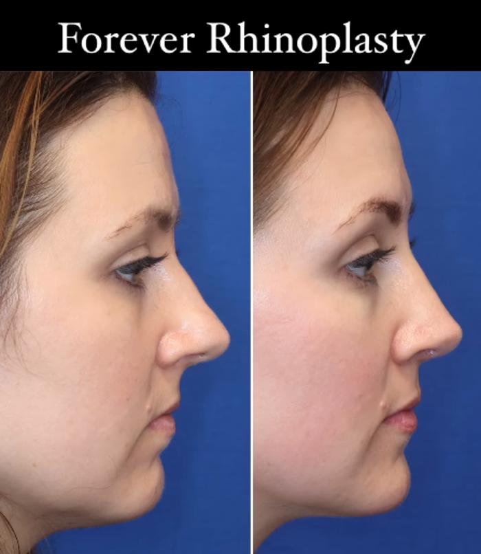 RENU by Dr. Philip S Schoenfeld (Plastic Surgeon)